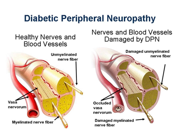 Nerve damage (Neuropathy)